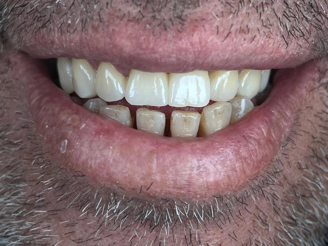 Avant traitement soins dentaires BioDental Annaba